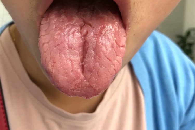 阴虚液涸舌裂图