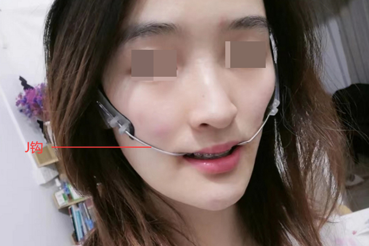 口腔正畸的J钩使用图