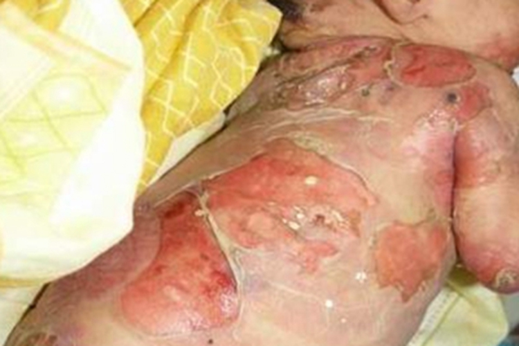 大疱性表皮松解症背部溃疡图 大疱性表皮松解症背部溃疡图