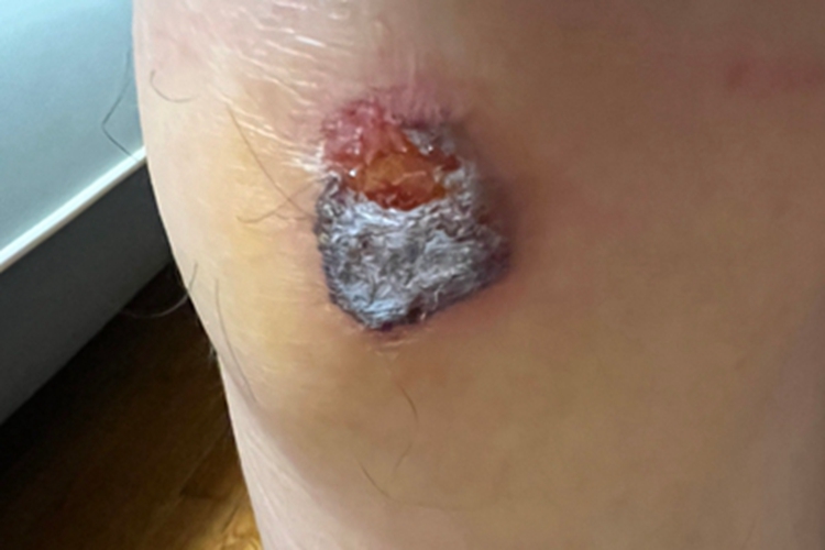 擦伤膝盖症状图