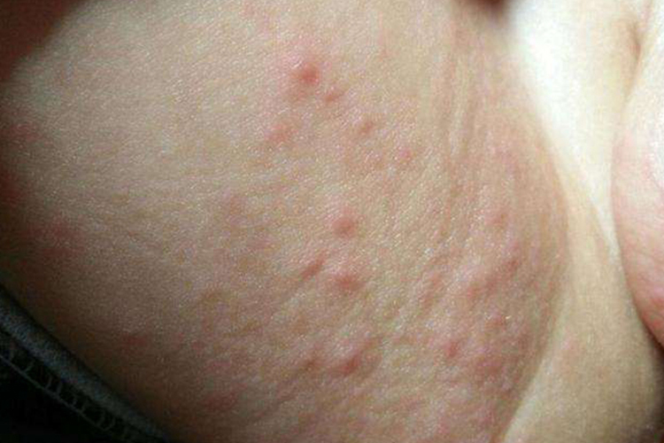 宝宝大腿根亚急性湿疹图