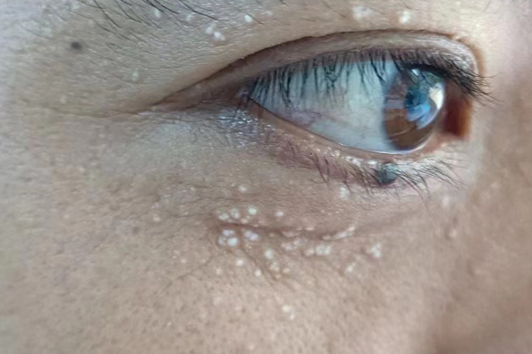 眼睛下面长小颗粒图片