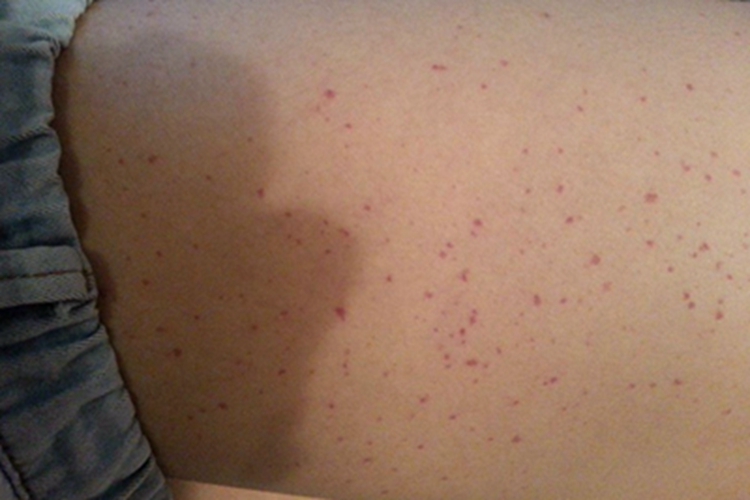 单纯性紫癜腰部血点图