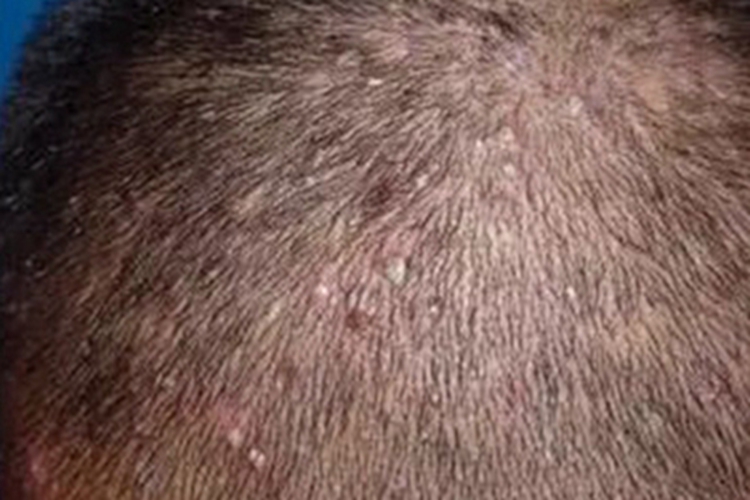 白塞病头皮上有白色脓包图