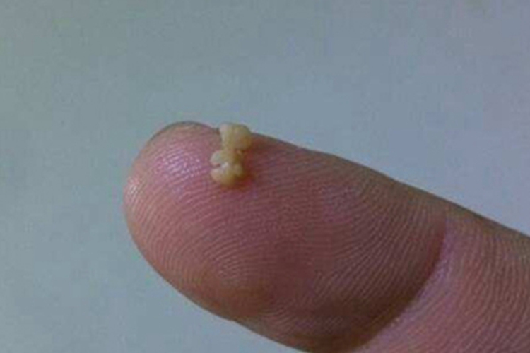 喉咙咳出黄褐色干痂皮图