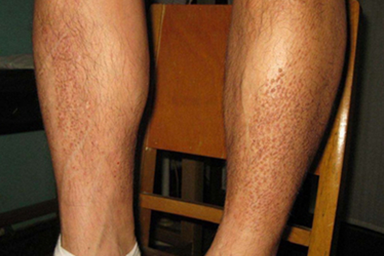 皮肤淀粉样变小红疙瘩图 皮肤淀粉样变小红疙瘩图