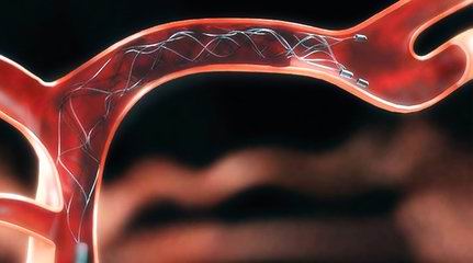 腹腔血管畸形图片