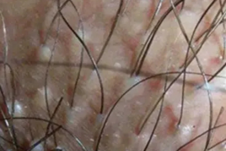 白色毛结节菌病症状图 白色毛结节菌病症状图