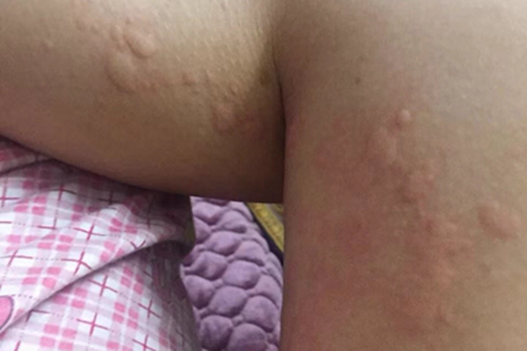 荨麻疹型药疹腿风团图 荨麻疹型药疹腿风团图
