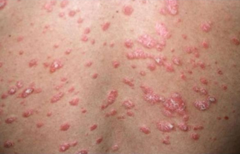 白血病前兆皮肤非特异性红疹图