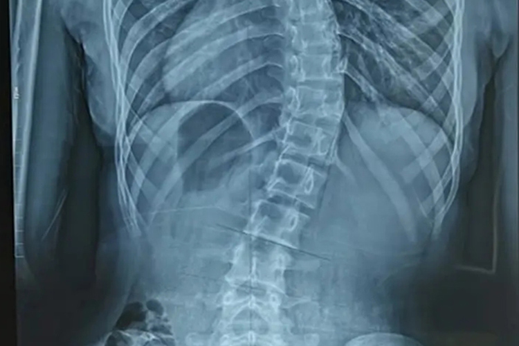 脊柱侧弯影像图 脊柱侧弯影像图