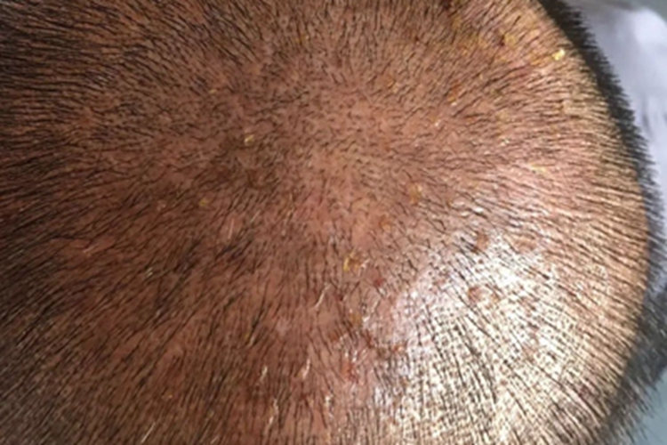 脱发性毛囊炎结痂图