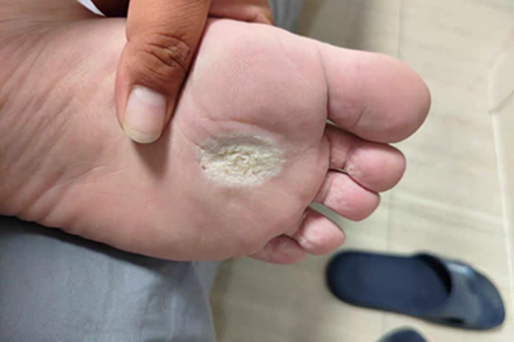 胼胝脚掌有个粗糙的硬块图 胼胝脚掌有个粗糙的硬块图