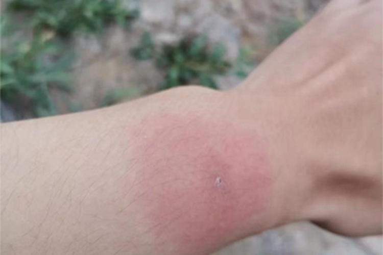 蜱叮咬症状图 蜱叮咬症状图