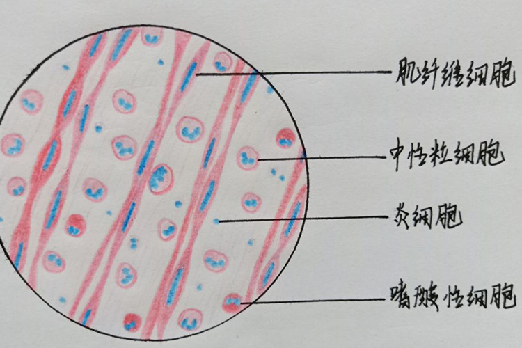 蜂窝织炎性阑尾炎红蓝铅笔图