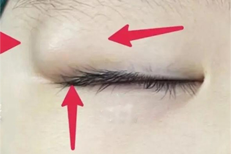 皮样囊肿肿块图