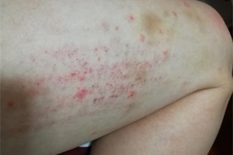 湿疹型多形性日光疹大腿症状图