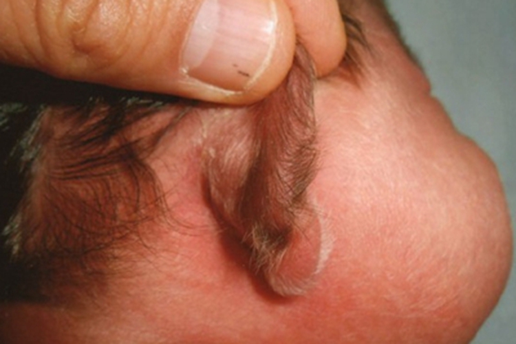 多毛症耳廓毛发过长图
