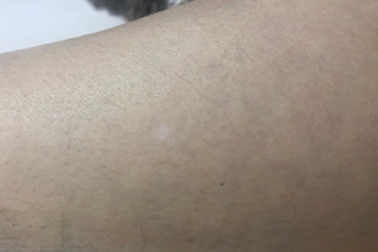 老年性白斑小腿白斑图