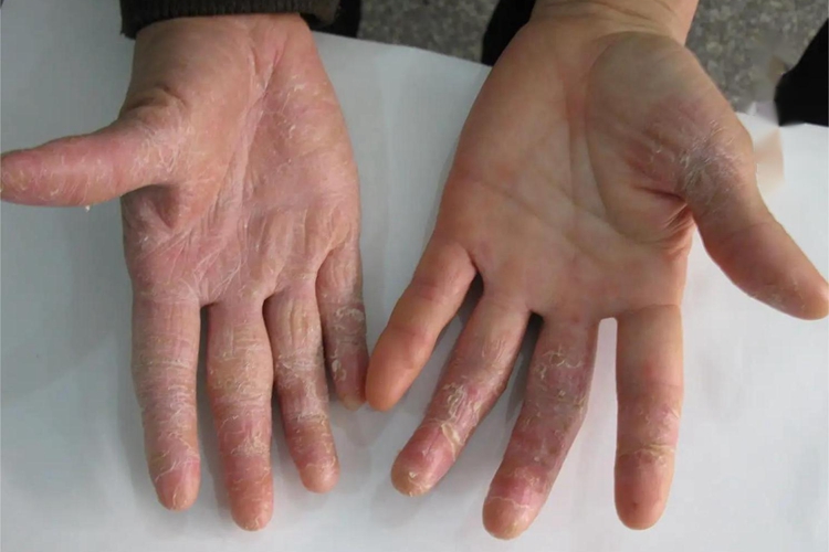 进行性指掌角皮症脱皮图