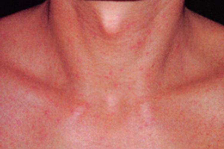 胆碱能性荨麻疹症状图