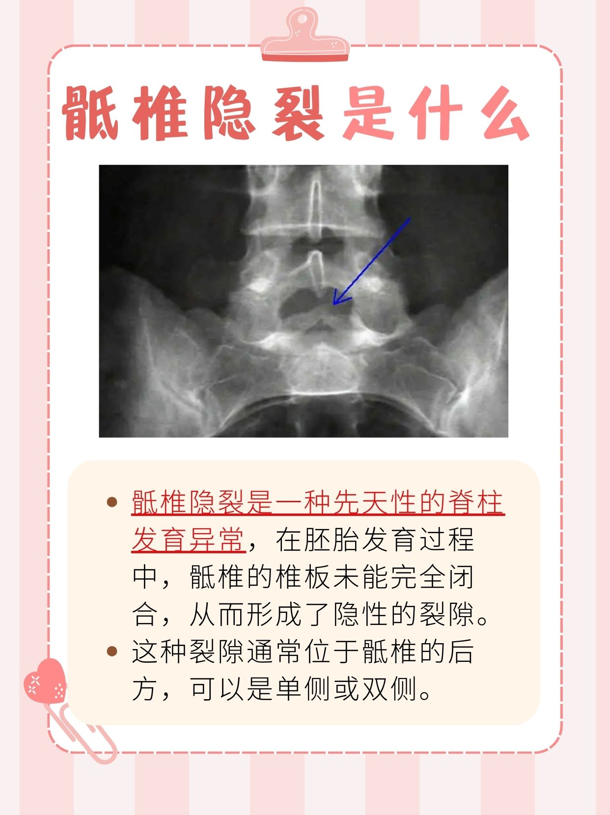 骶椎隐裂：你知道多少？一文解析