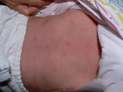 新生儿毒性红斑背部有小丘疹还发红图.jpg