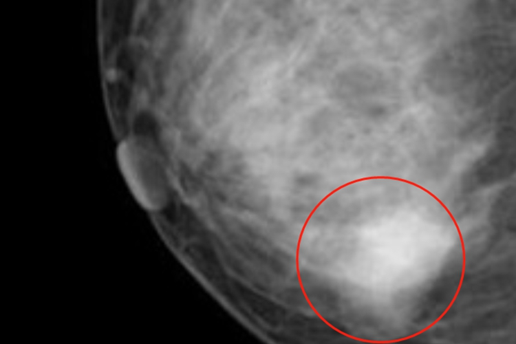 乳腺增生乳房结节影像学图