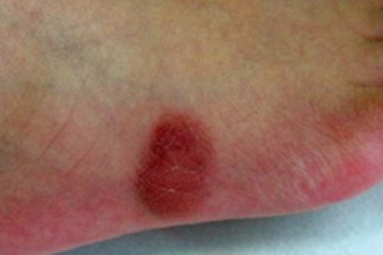 皮肤肥大细胞瘤脚部红斑图 皮肤肥大细胞瘤脚部红斑图