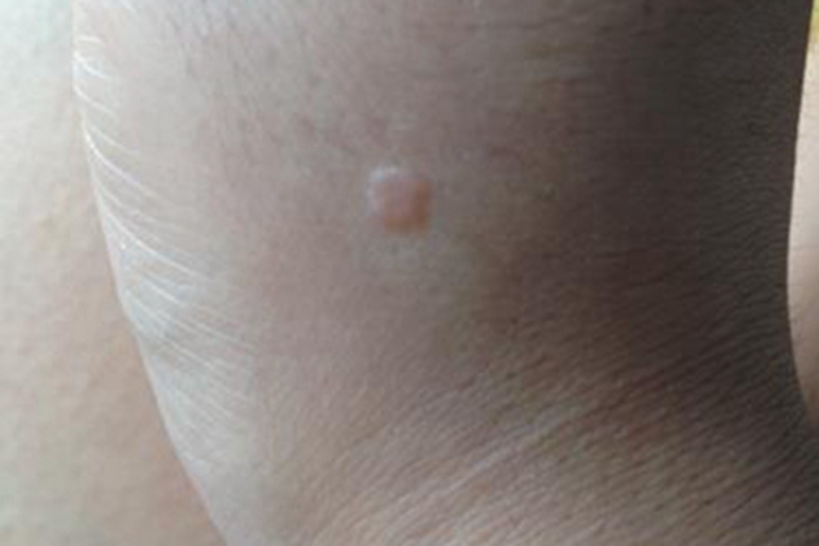 扁平疣手背长了个圆形斑块图