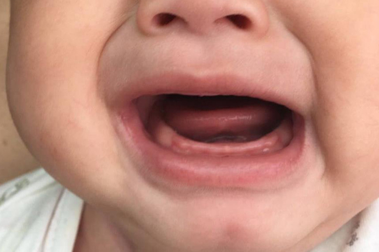 婴儿牙床正常图 婴儿牙床正常图