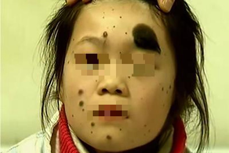 兽皮痣面部黑点图