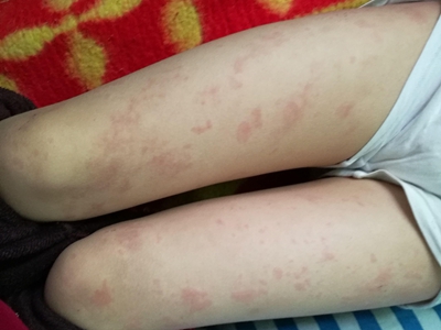 普通型猩红热两条大腿上有很多红疹子图.jpg