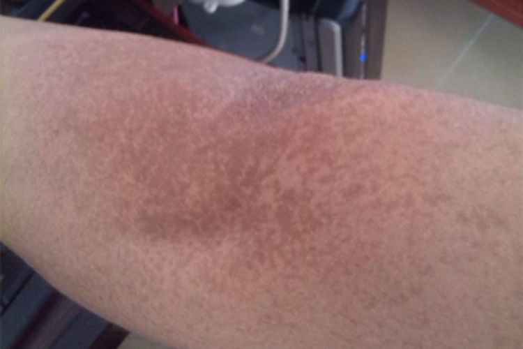 血管萎缩性皮肤异色病小腿斑图