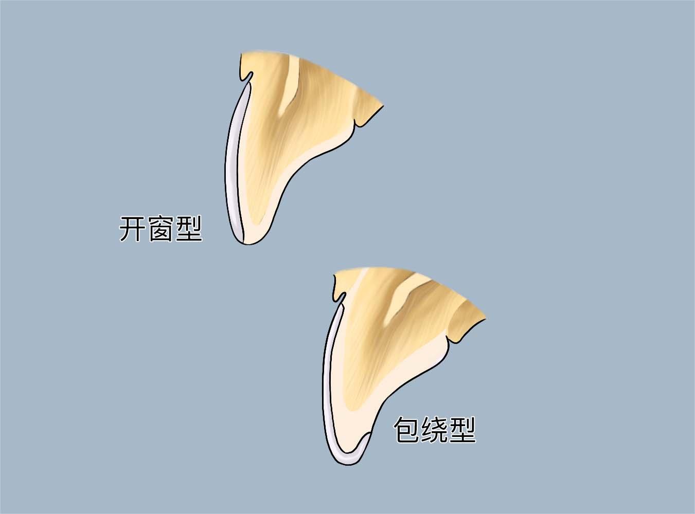 牙齿贴面开窗和包绕切缘制备图