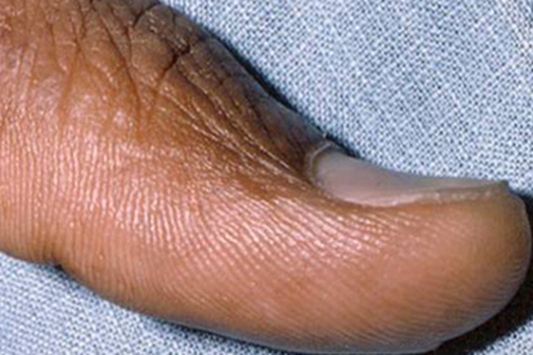 缺铁性贫血指甲翘起来图 缺铁性贫血指甲翘起来图