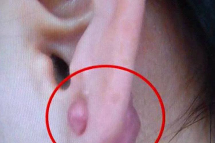 瘢痕疙瘩耳部长大红疙瘩图