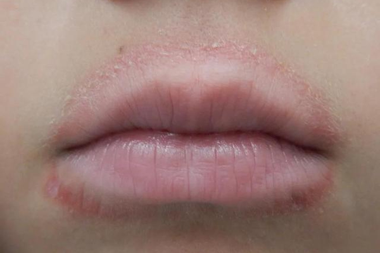 口角炎孩子嘴巴周围白一圈图 口角炎孩子嘴巴周围白一圈图