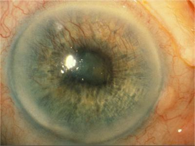 新生血管性青光眼前期眼珠里有红血丝图.jpg