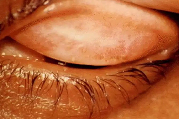 退行期沙眼眼睑症状图 退行期沙眼眼睑症状图