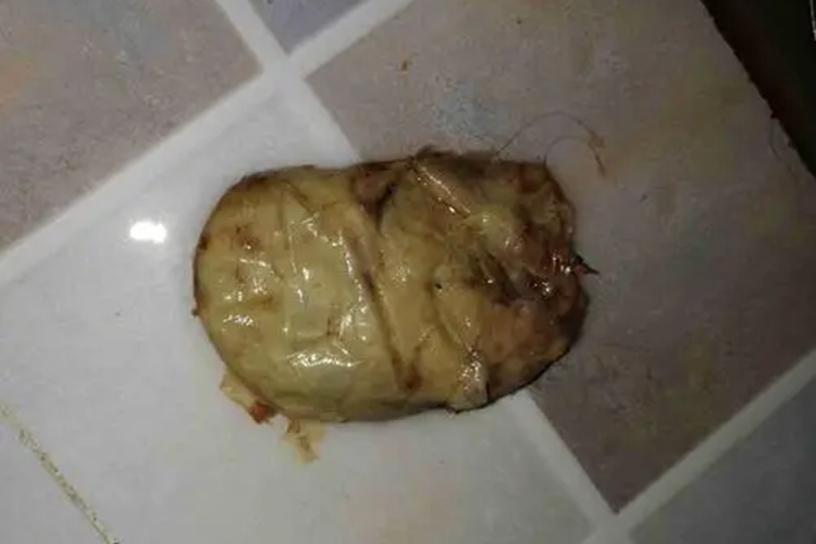 流产后的孕囊图 流产后的孕囊图