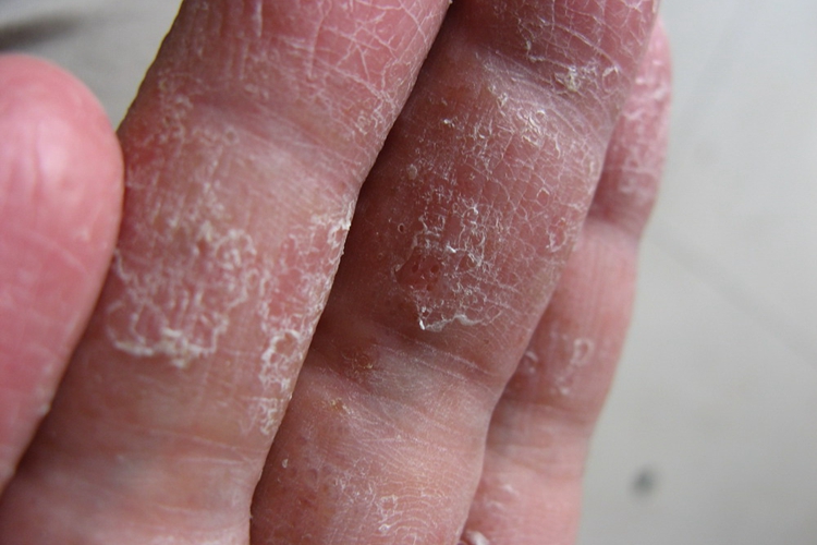 鳞屑角化型手癣图