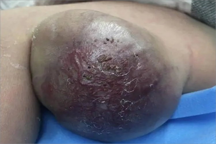 静脉畸形腿症状图