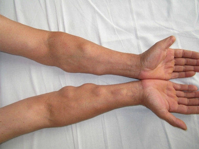 Ⅲ型痛性肥胖病胳膊上很多结节图