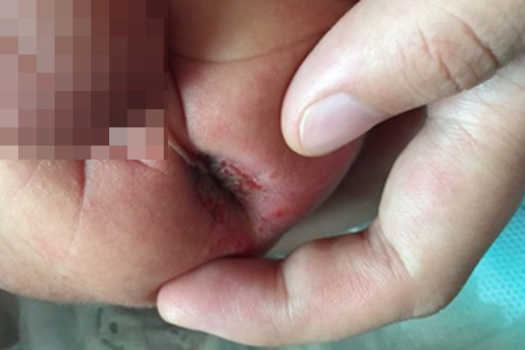 女宝宝轻微肛裂图 女宝宝轻微肛裂图