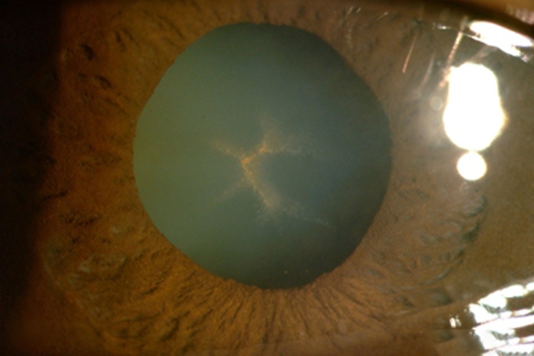 氯丙嗪所致的白内障眼球斑图