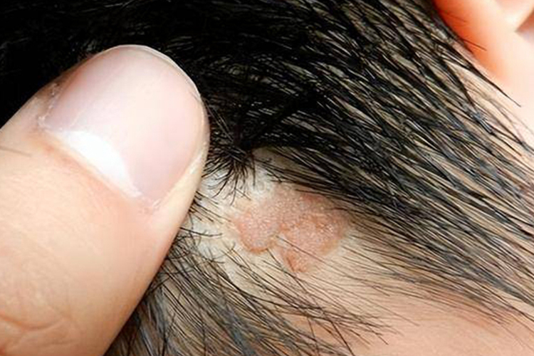 头皮上多发型皮赘图 头皮上多发型皮赘图