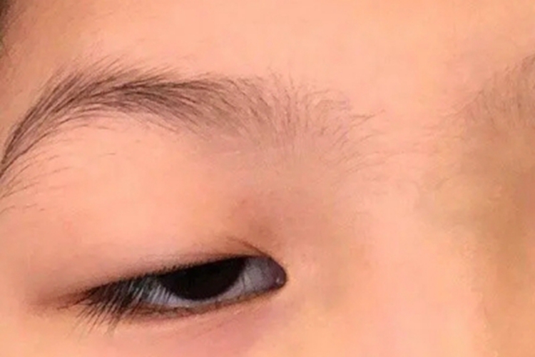 毒蛇咬伤眼睑症状图