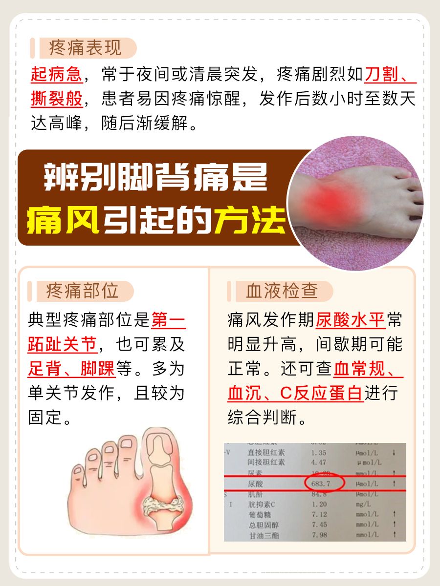 脚背痛怀疑是痛风？几招教你快速辨别！