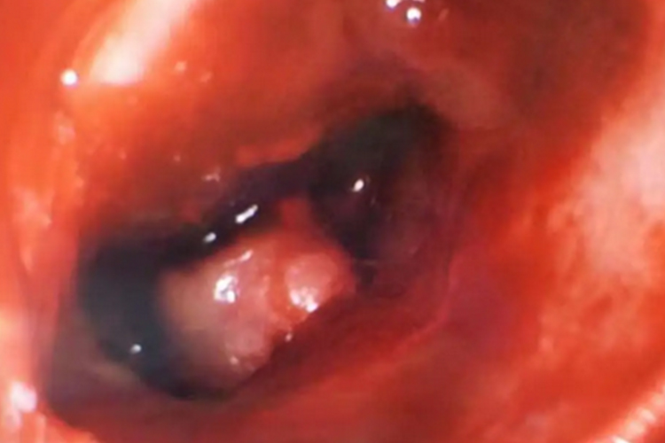 鼻部额窦骨瘤图